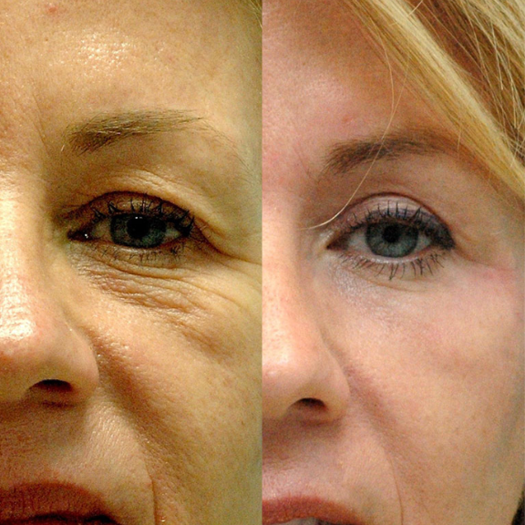 ultraformer região dos olhos antes e depois