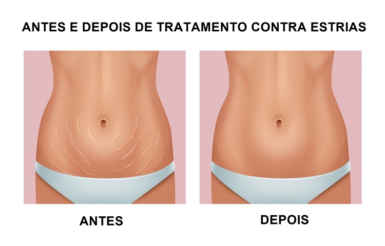 tratamento estrias antes e depois